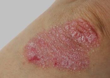 Kasus Penyakit Kulit di Bontang Meningkat, Psoriasis Jadi Sorotan