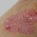 Kasus Penyakit Kulit di Bontang Meningkat, Psoriasis Jadi Sorotan