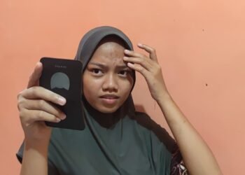 Kulit Rusak karena Stres, dr. Dewi: Pentingnya Mengelola Psikis untuk Kesehatan Fisik